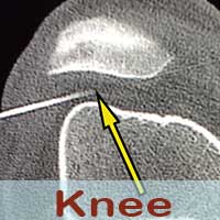 knee